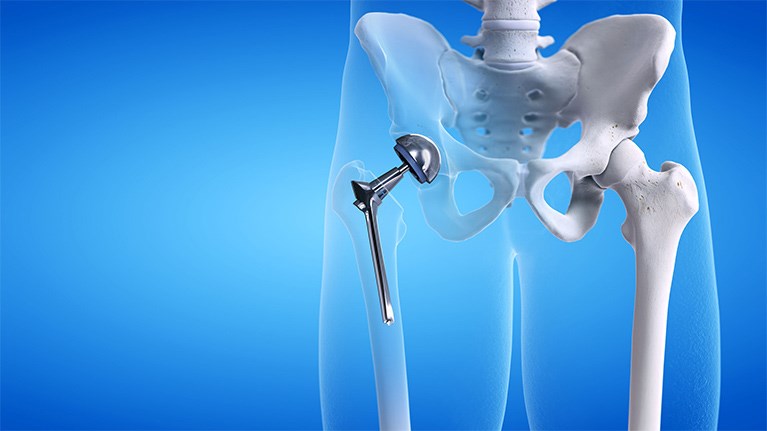 Orthopedic Surgery Options