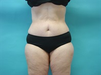 Dr. Serra Plastic Surgery Before & After