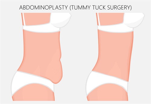 Tummy tuck before and after