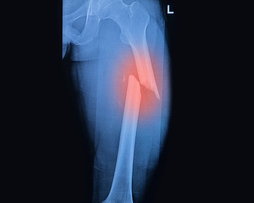 Types of Broken Bones