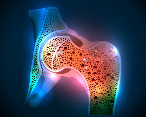 Bone Density VS. Bone Quality — Is there a difference?